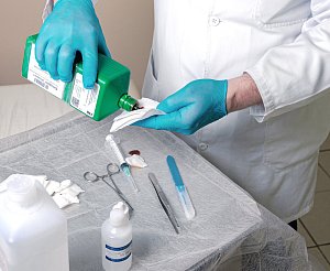 Иссечение свища прямой кишки